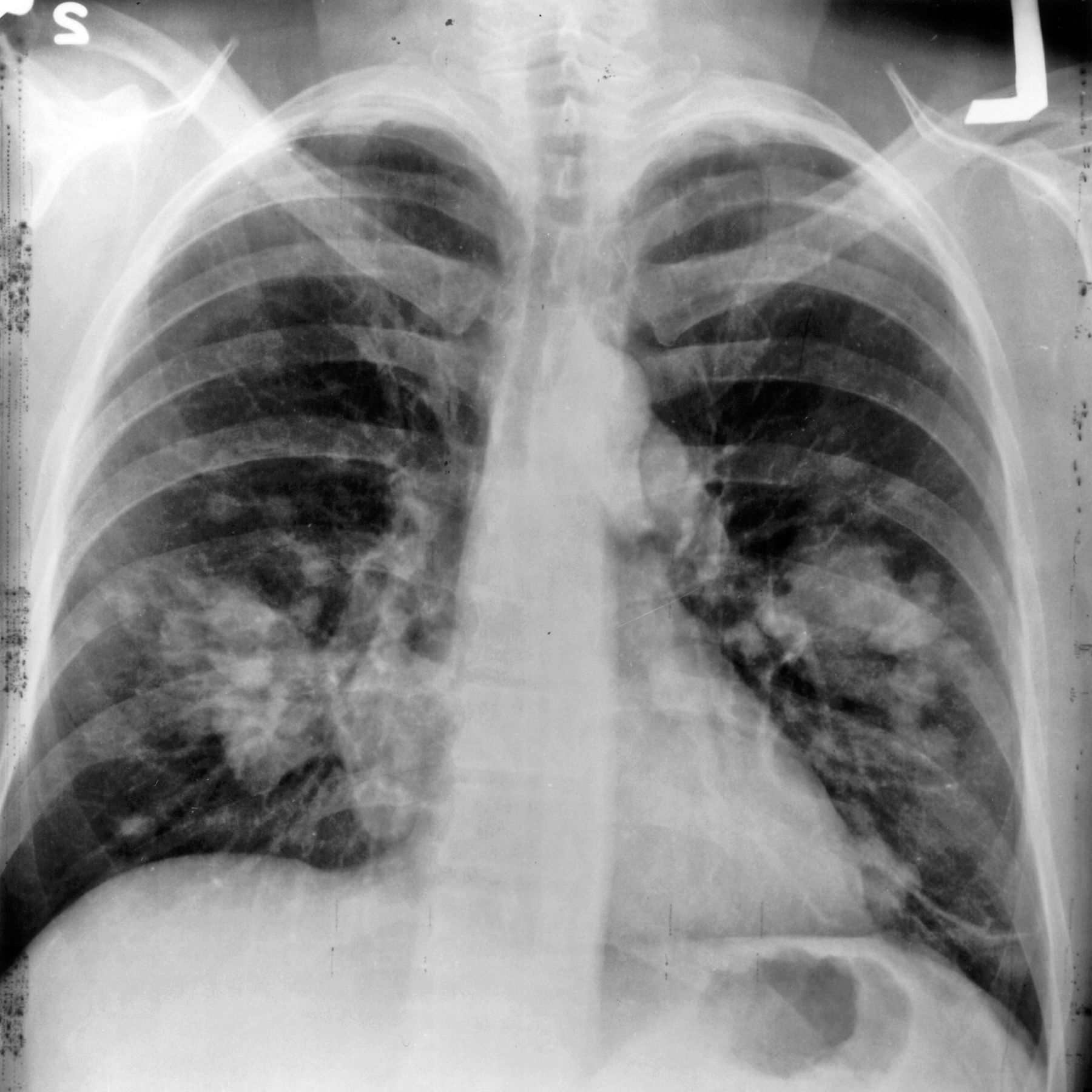 🎗 Layer X-ray detects lung cancer in time
