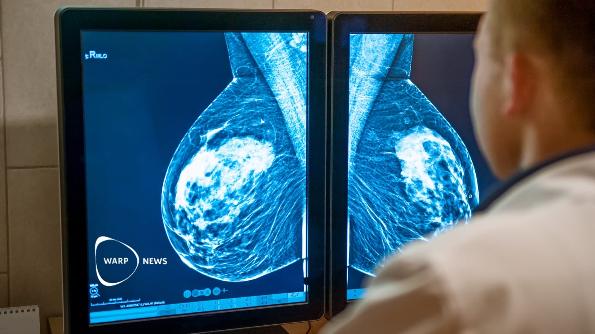 👩‍⚕️ AI-supported mammography reduces missed cancer cases
